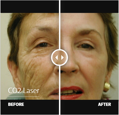 CO2 laser before and after