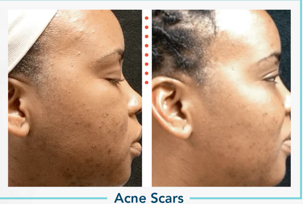 acne-scars